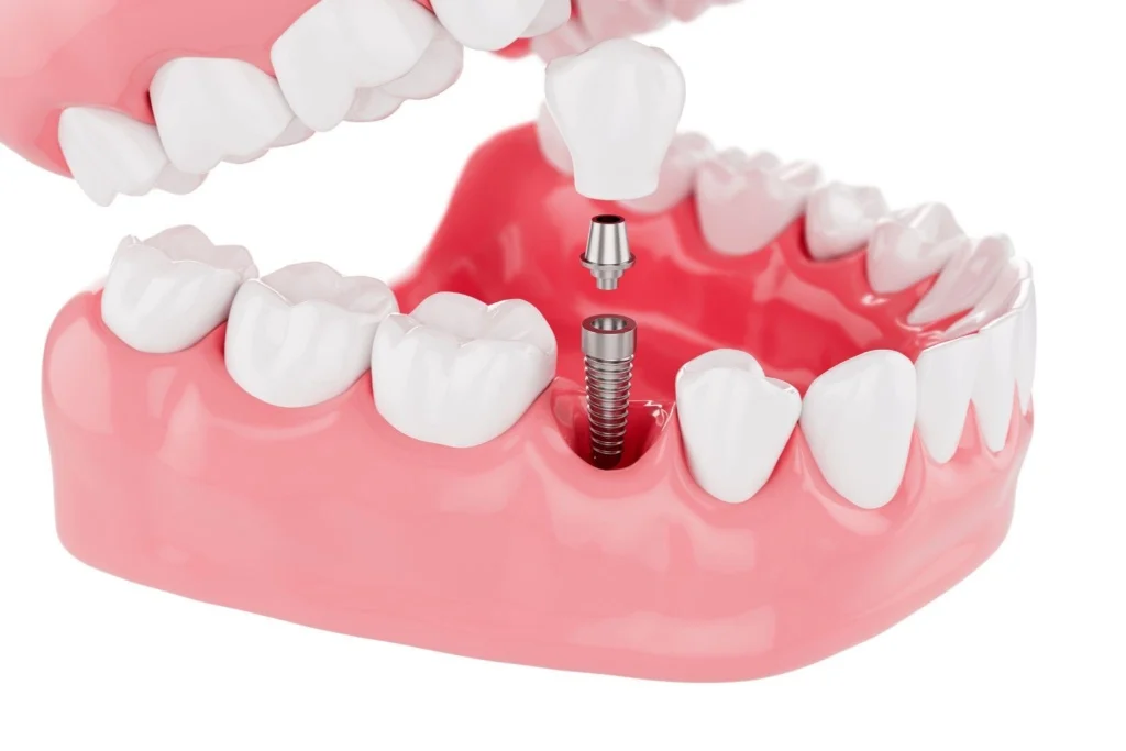 Image-illustrating-dental-implants-in-Albania-1-1024x683